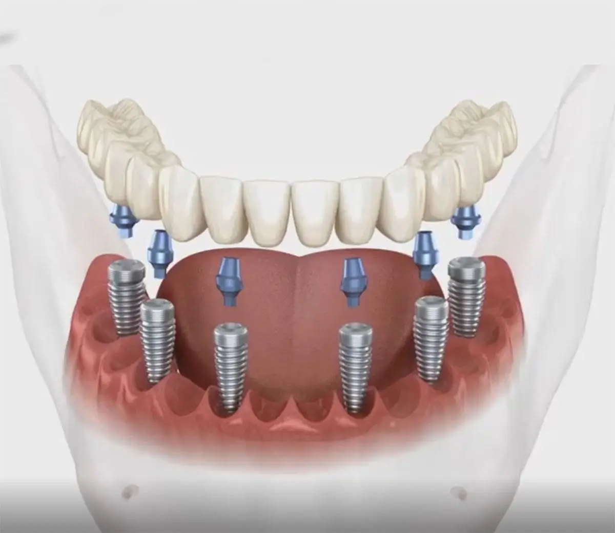 All in 6 Remplacer toutes les dents d'une arcade grâce à 6 implants dentaires supportant un bridge fixe complet