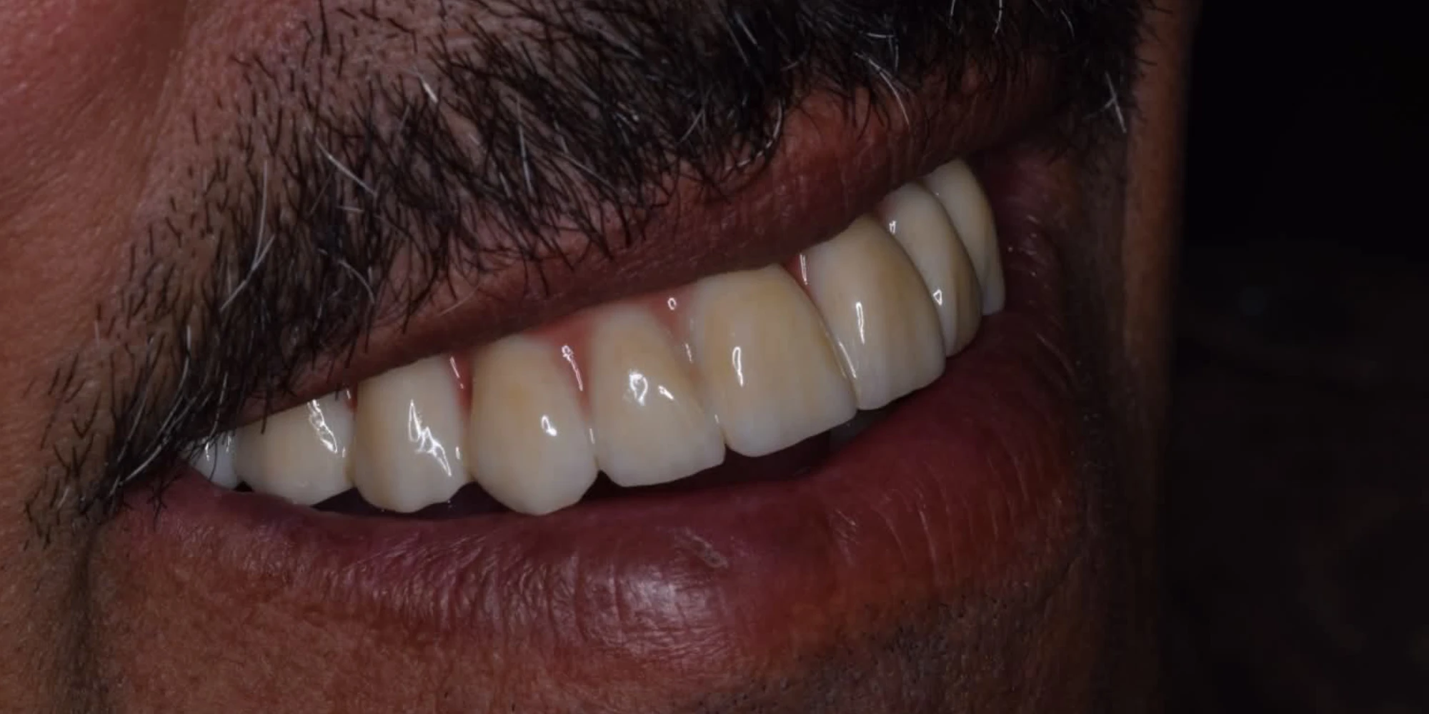 full arch all in 6 apres
